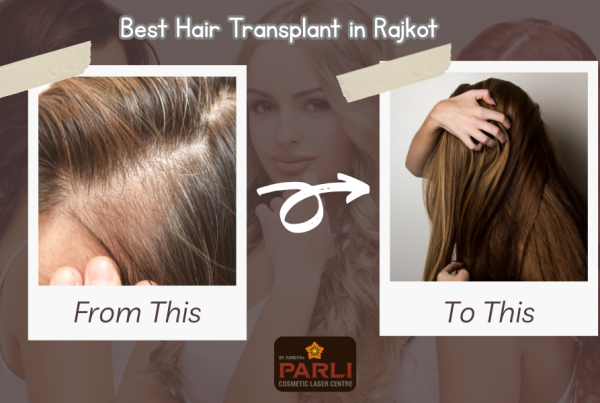 Best Hair Transplant in Rajkot A Story of Confidence, Care, and Permanent Transformation